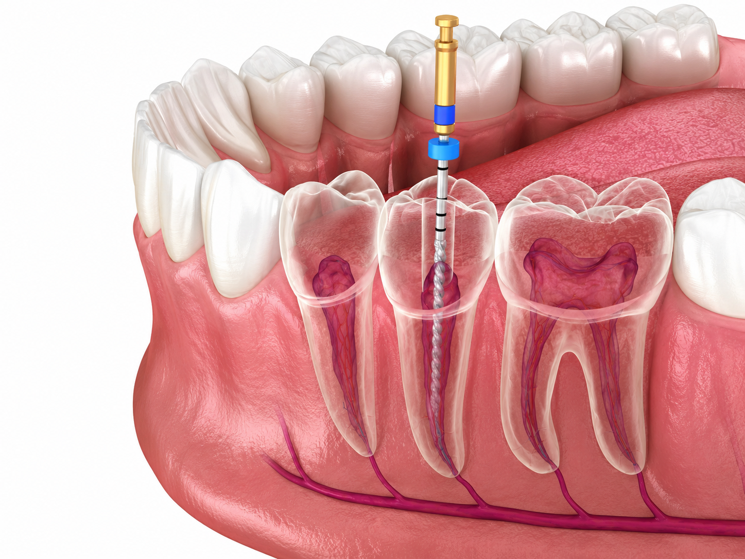 Kanal Tedavileri (Endodonti)